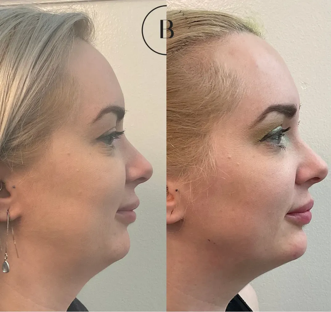 Lower Face Refinement before and after results at Boujee Nurse