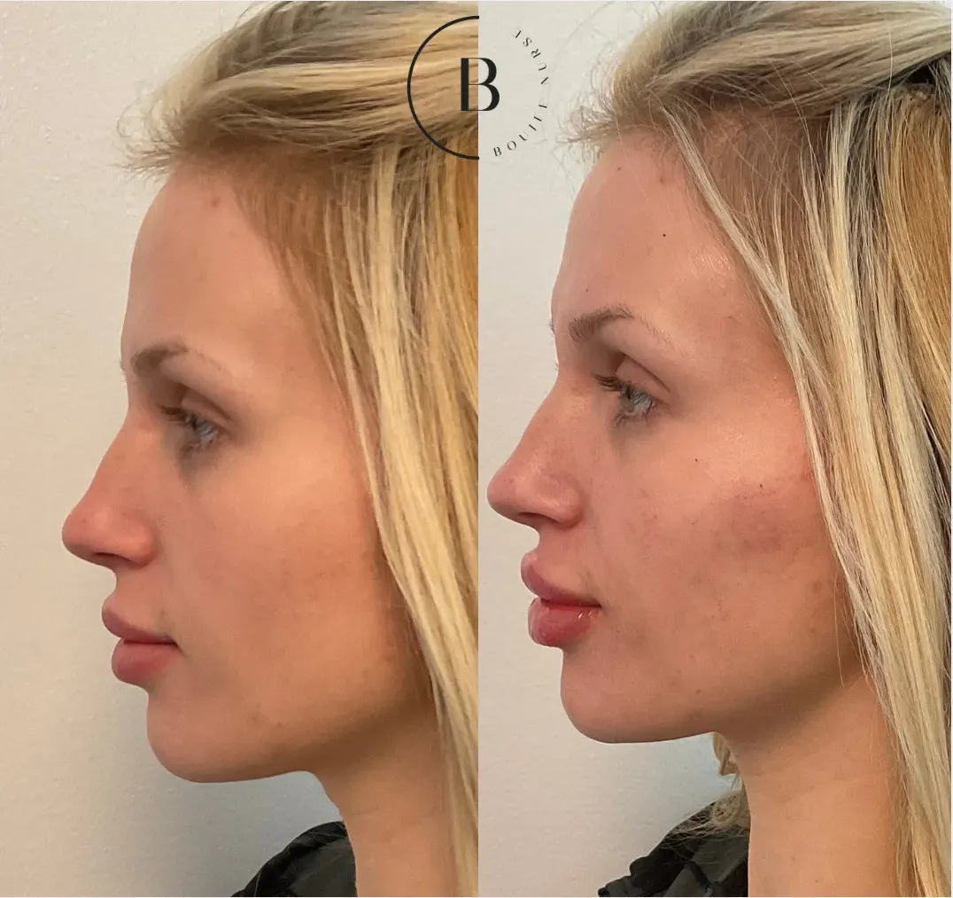 Lip Enhancement before and after results at Boujee Nurse