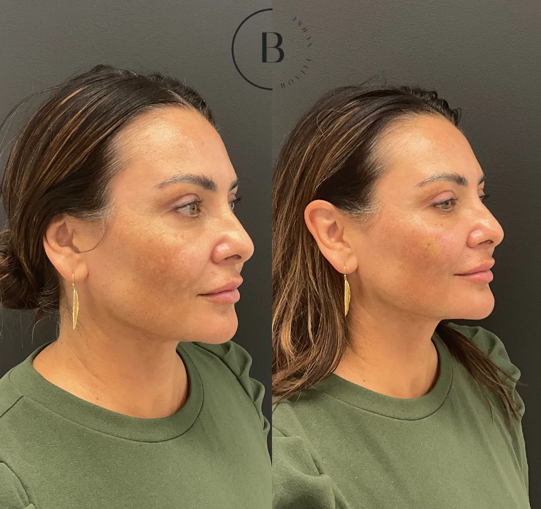 Full Facial Balancing before and after results at Boujee Nurse
