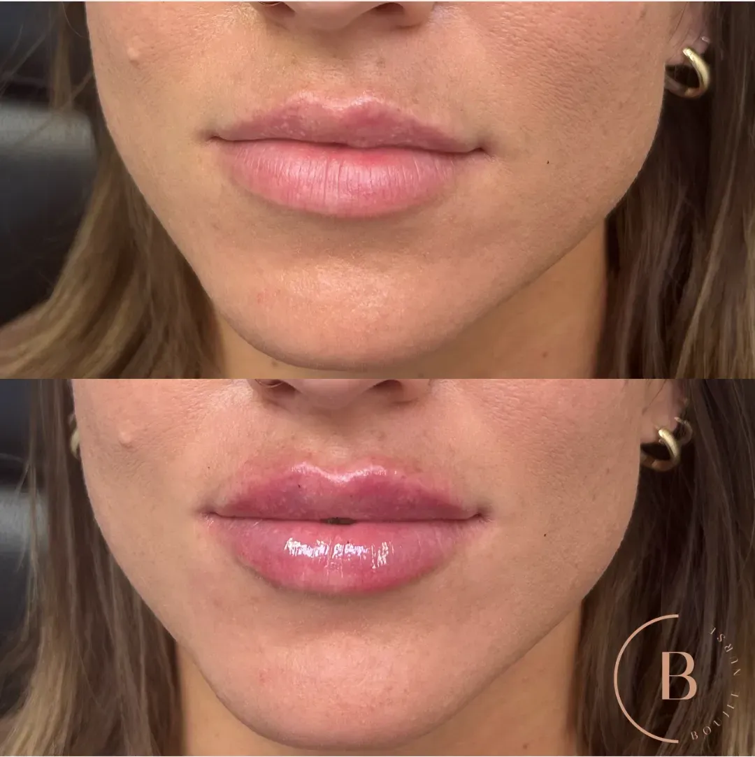 Lip Enhancement before and after results at Boujee Nurse