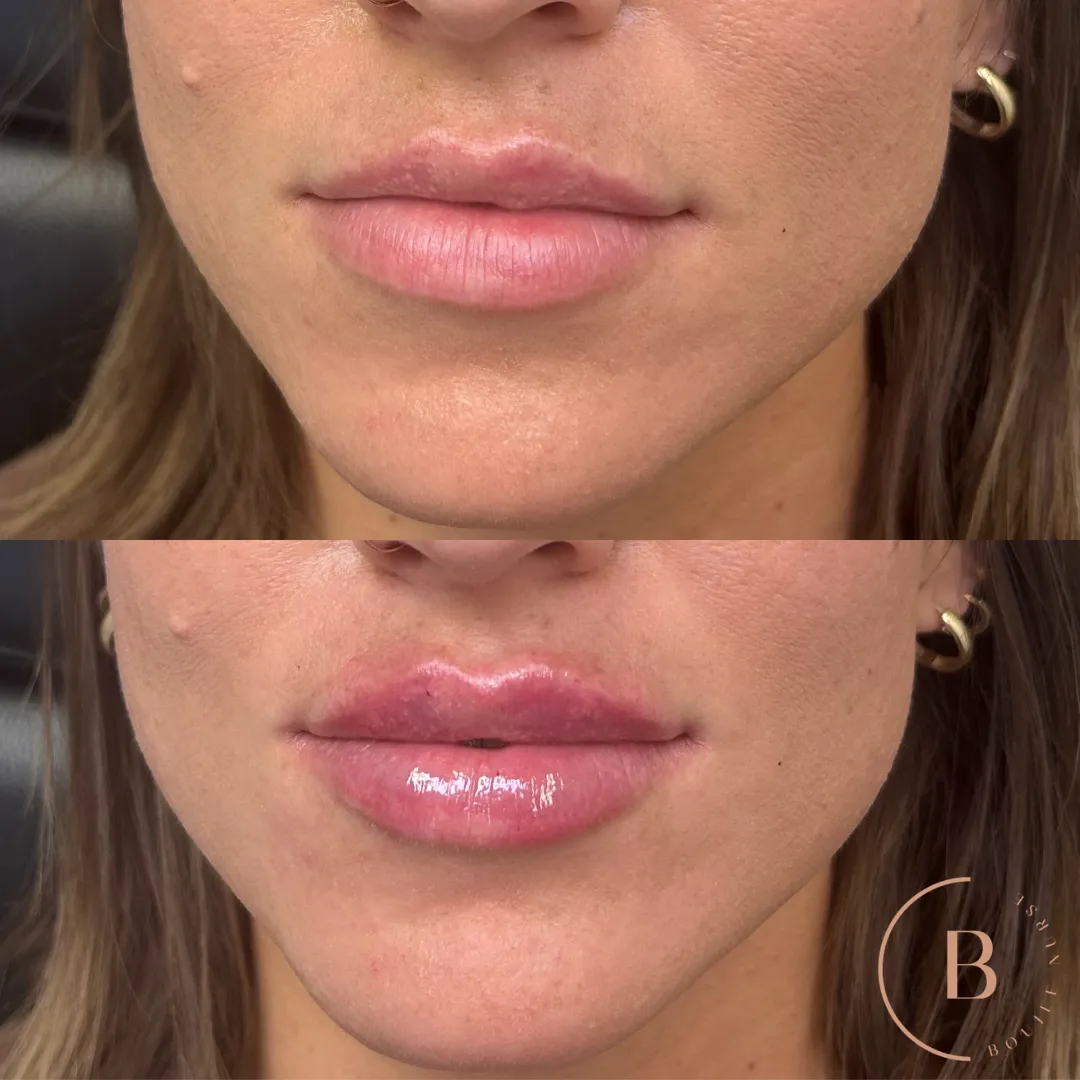 Lip Enhancement before and after results at Boujee Nurse