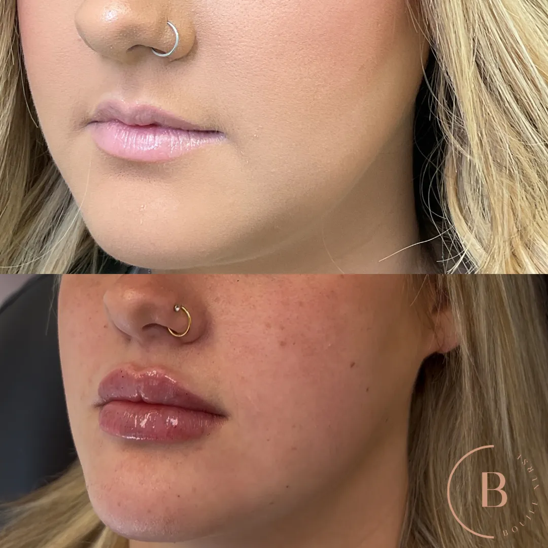 Lip Enhancement before and after results at Boujee Nurse