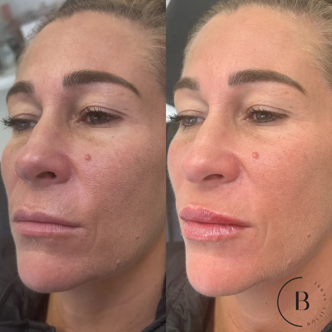Lip Enhancement before and after results at Boujee Nurse