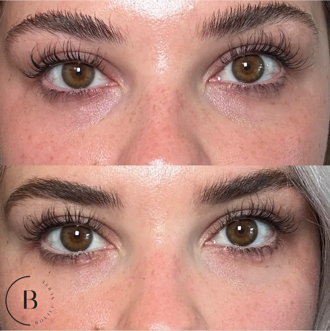 Under-Eye Rejuvenation before and after results at Boujee Nurse