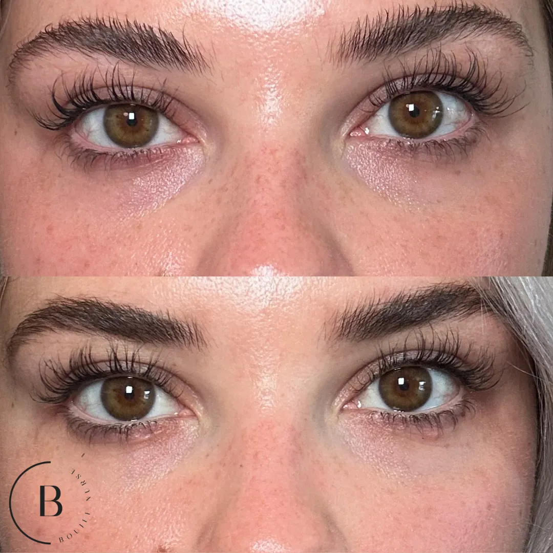 Under-Eye Rejuvenation before and after results at Boujee Nurse