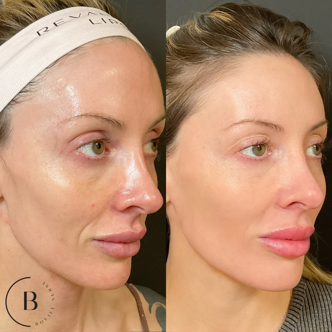 Laser Skin Renewal before and after results at Boujee Nurse