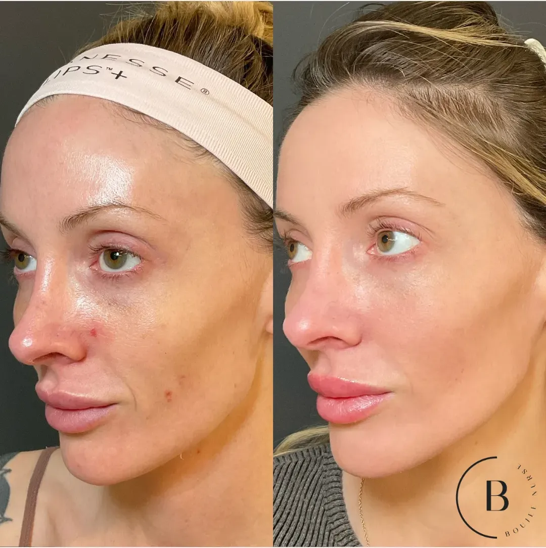 Laser Skin Renewal before and after results at Boujee Nurse