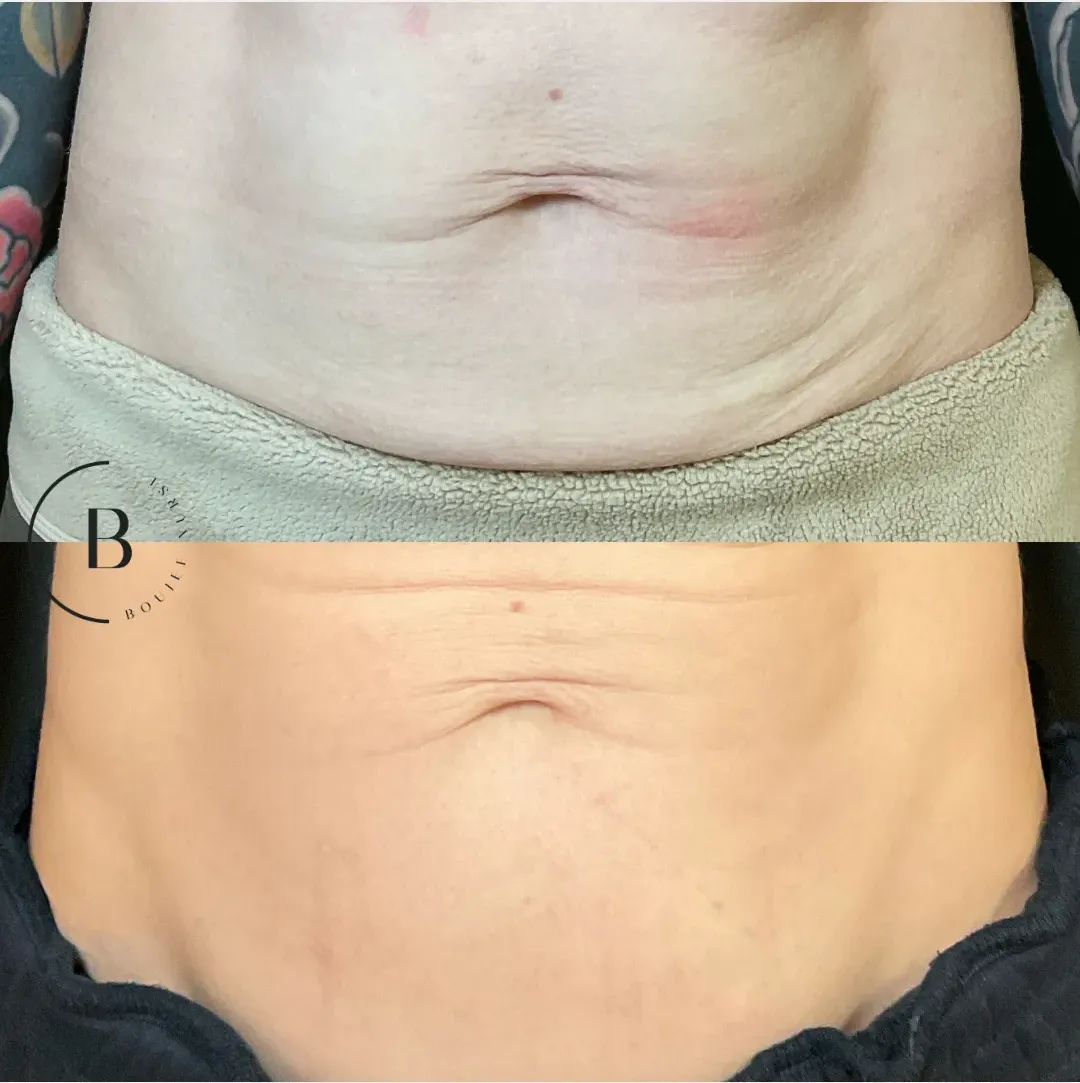 Abdominal Skin Tightening before and after results at Boujee Nurse
