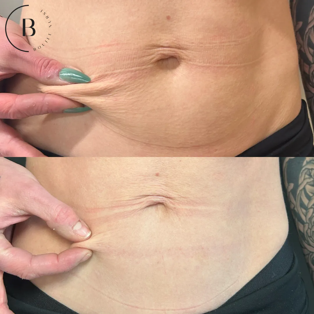 Abdominal Skin Tightening before and after results at Boujee Nurse