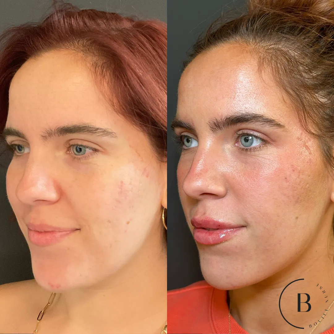 Lip Enhancement before and after results at Boujee Nurse
