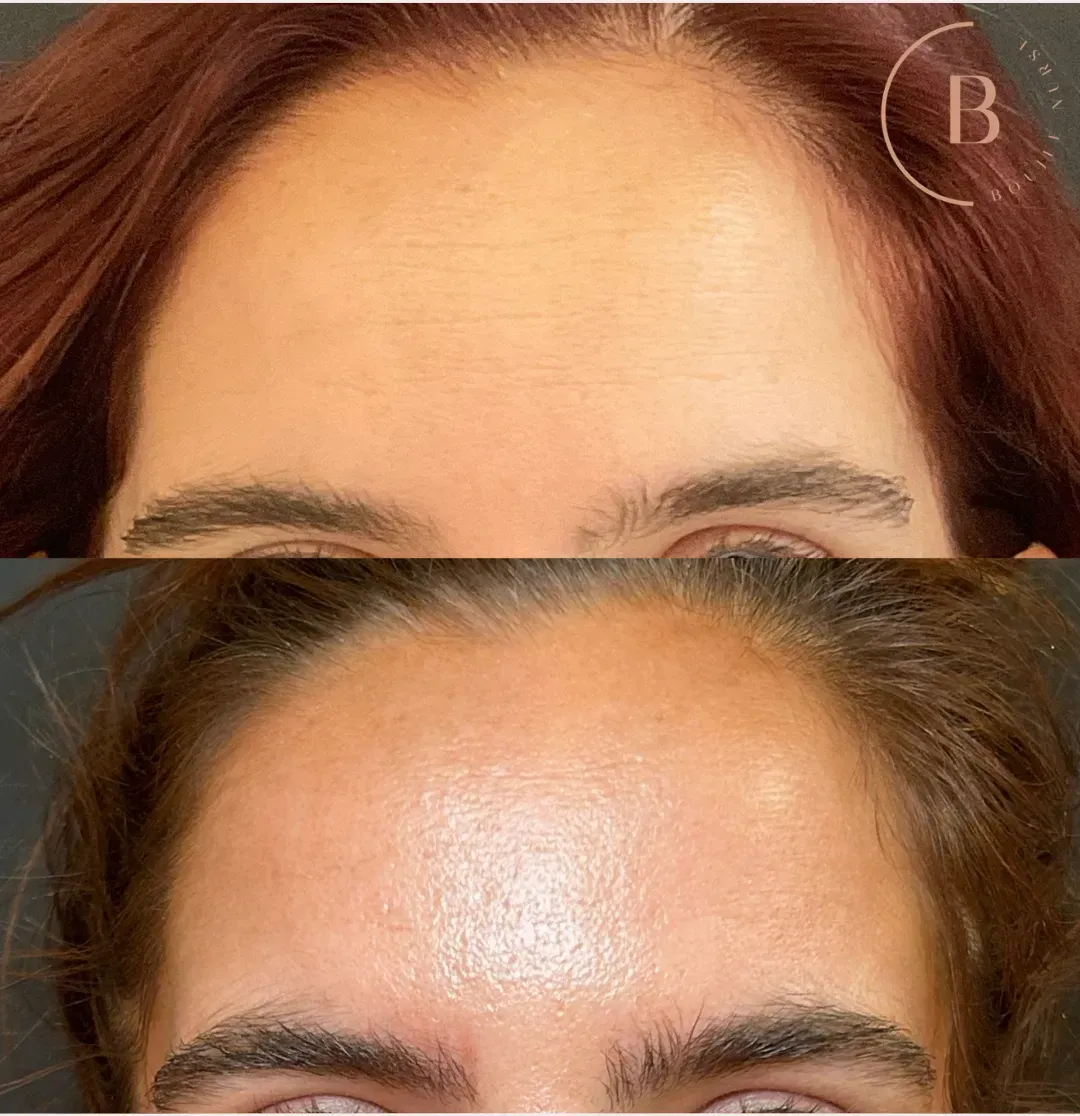 Fine Line Refinement before and after results at Boujee Nurse
