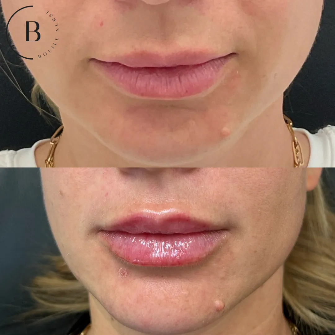 Lip Enhancement before and after results at Boujee Nurse
