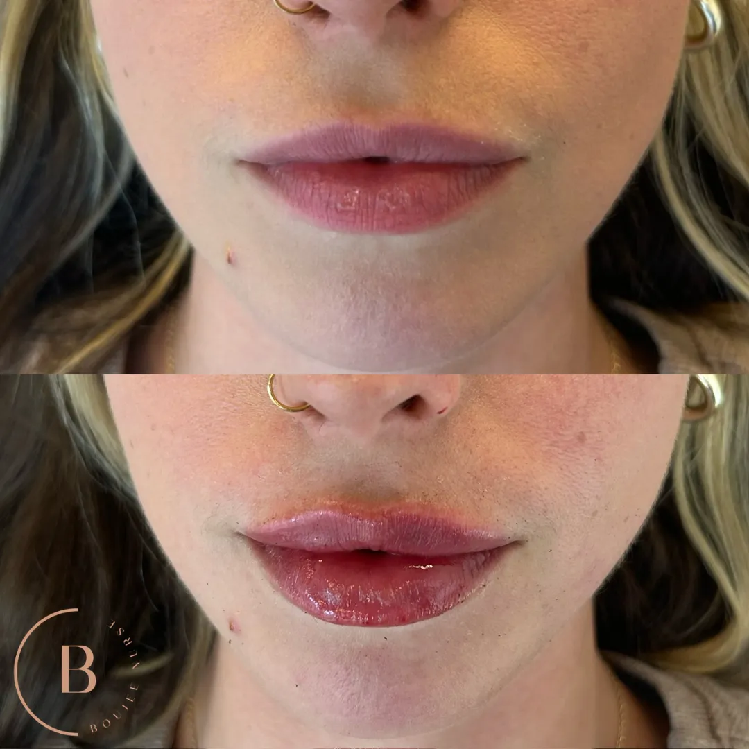 Lip Enhancement before and after results at Boujee Nurse