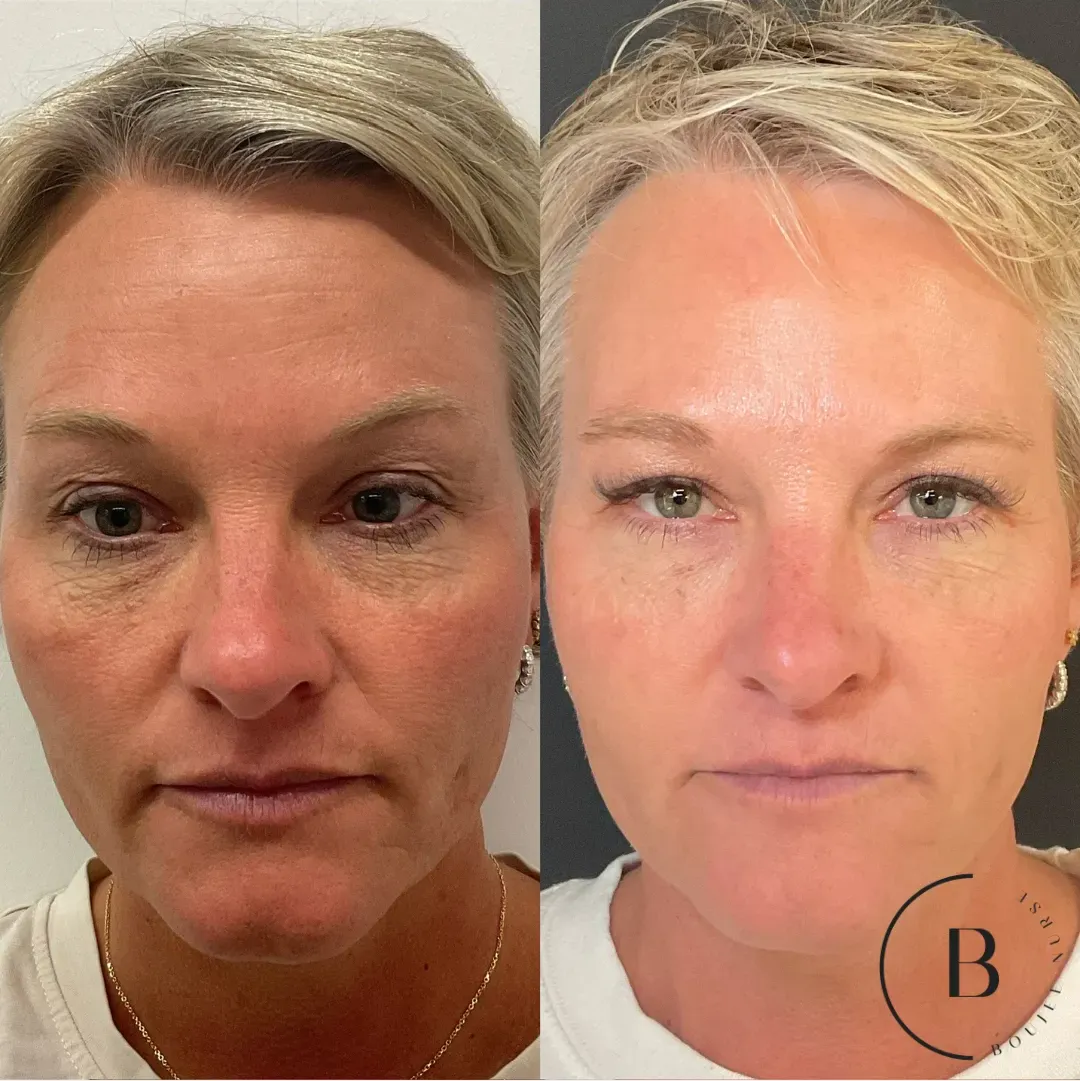 Collagen Restoration before and after results at Boujee Nurse