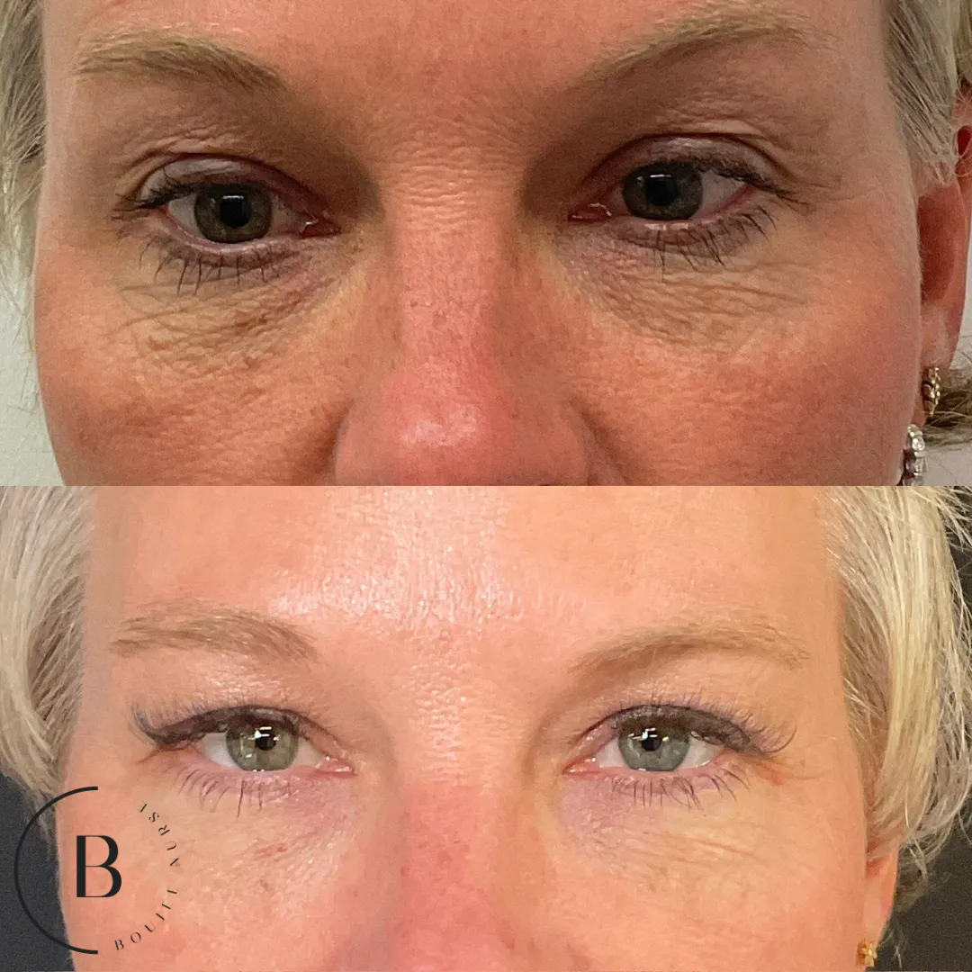 Under-Eye Rejuvenation before and after results at Boujee Nurse