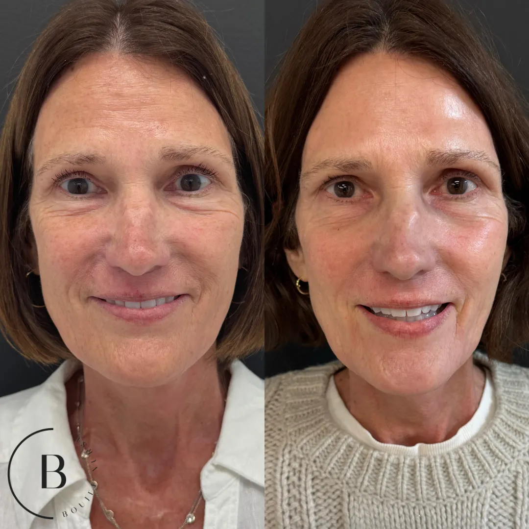 Collagen Restoration before and after results at Boujee Nurse