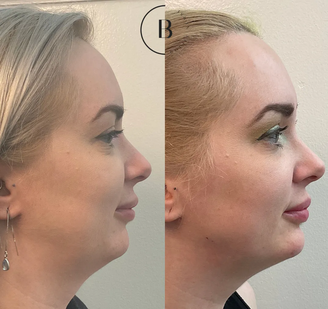 Lower Face Refinement before and after results at Boujee Nurse