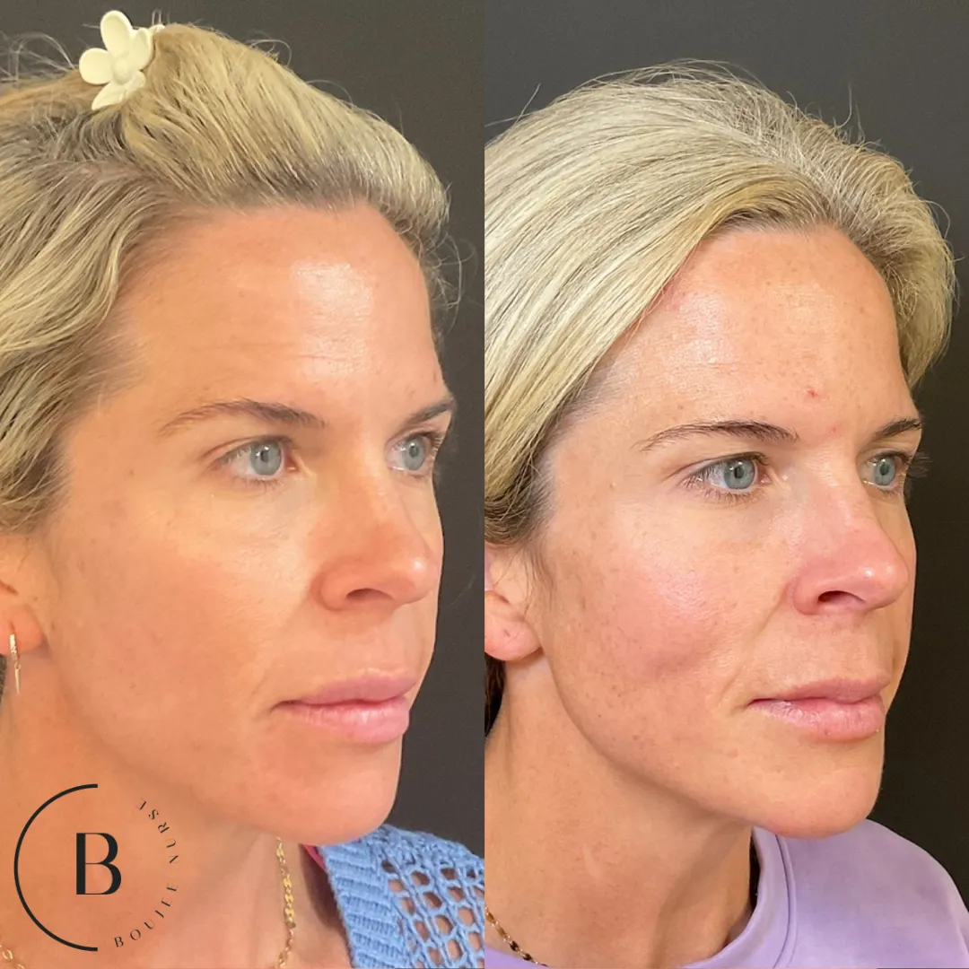 Volume Restoration before and after results at Boujee Nurse