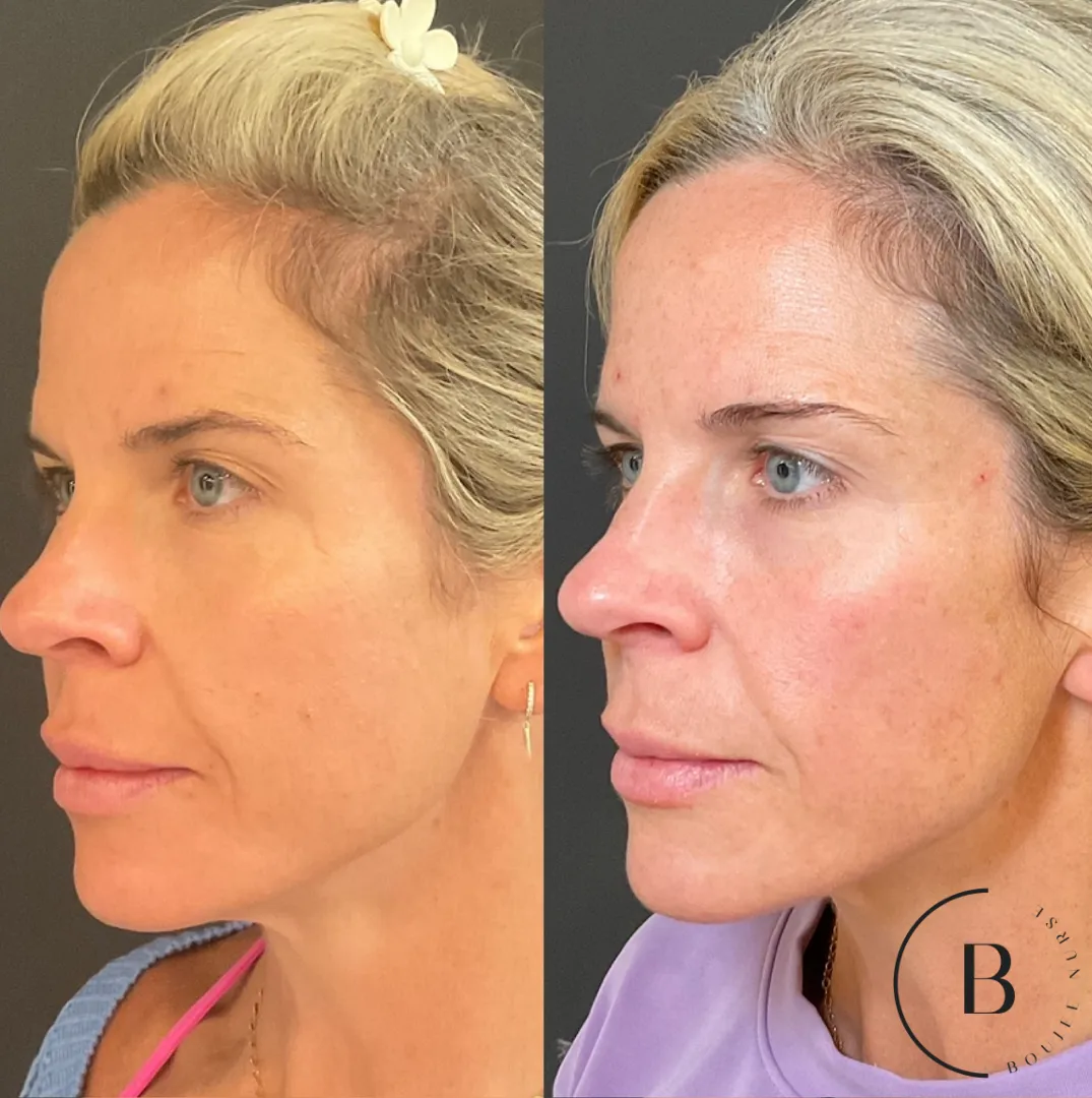 Volume Restoration before and after results at Boujee Nurse