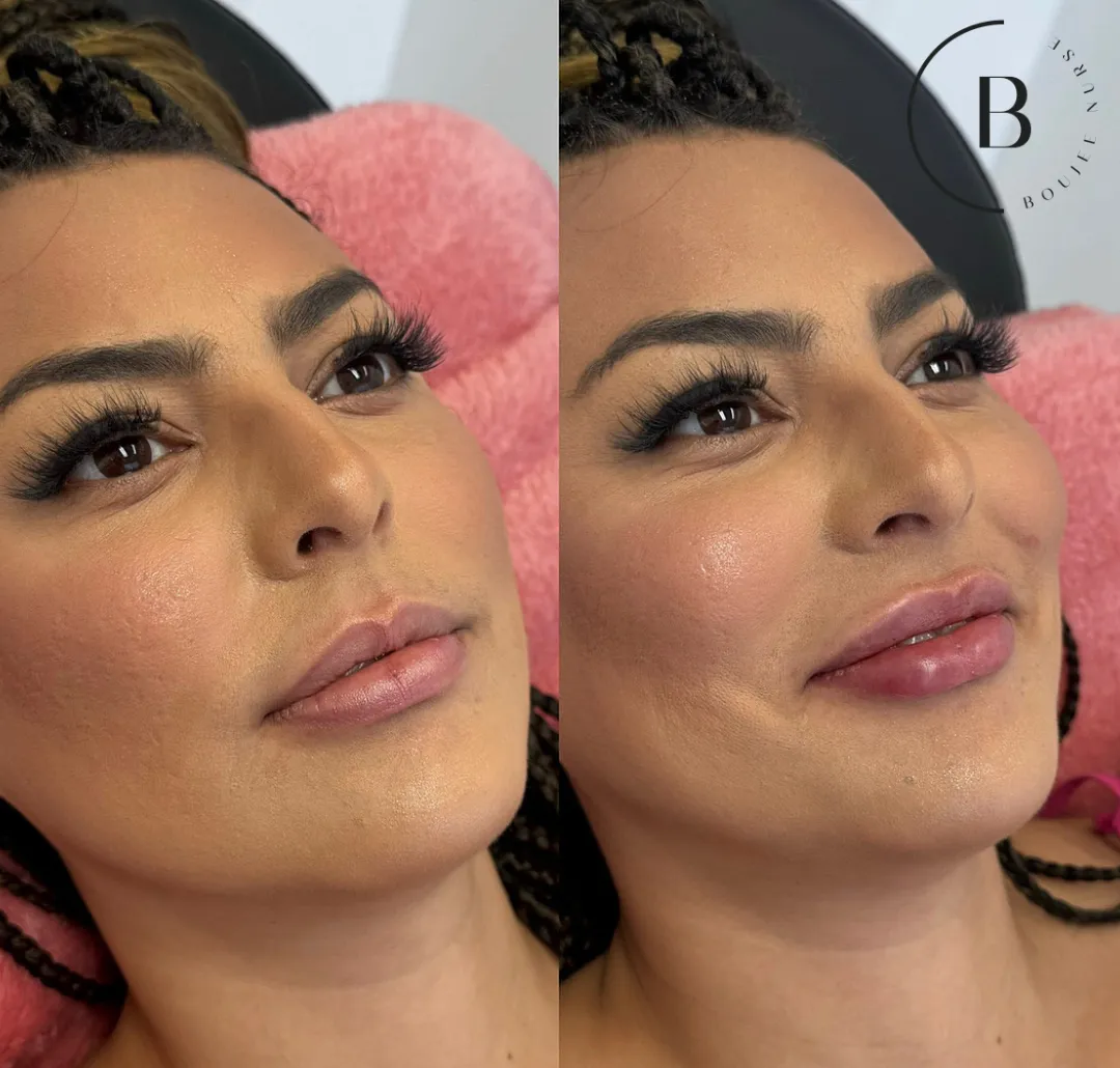 Lip Enhancement before and after results at Boujee Nurse
