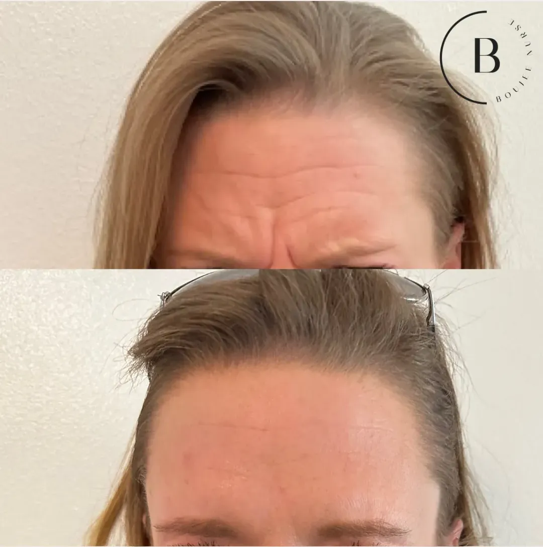 Wrinkle Relaxation before and after results at Boujee Nurse