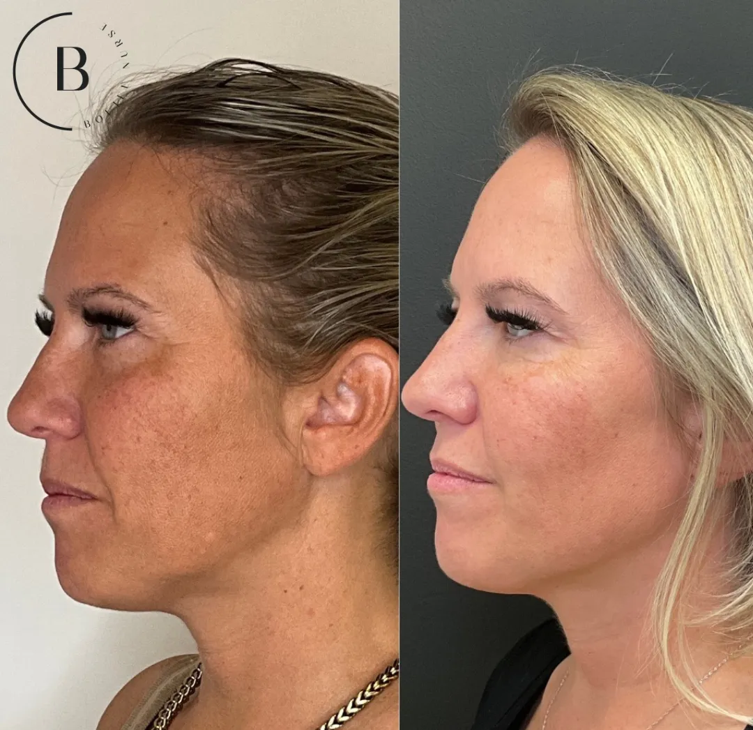Volume Restoration before and after results at Boujee Nurse
