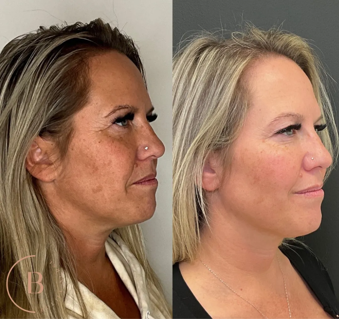 Volume Restoration before and after results at Boujee Nurse