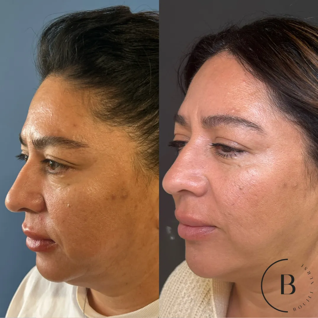 Full Facial Balancing & Skin Rejuvenation before and after results at Boujee Nurse