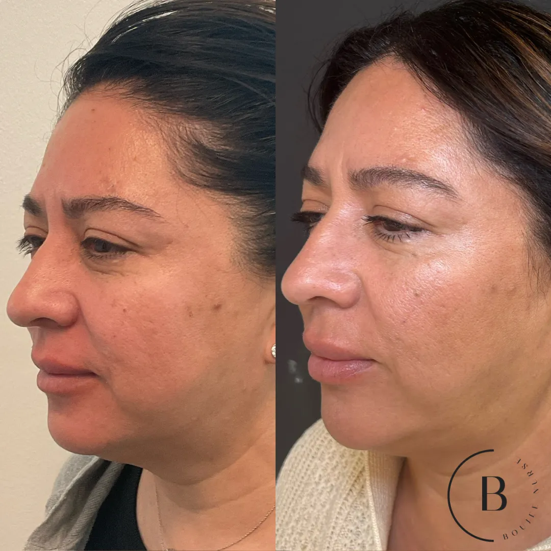 Full Facial Balancing & Skin Rejuvenation before and after results at Boujee Nurse