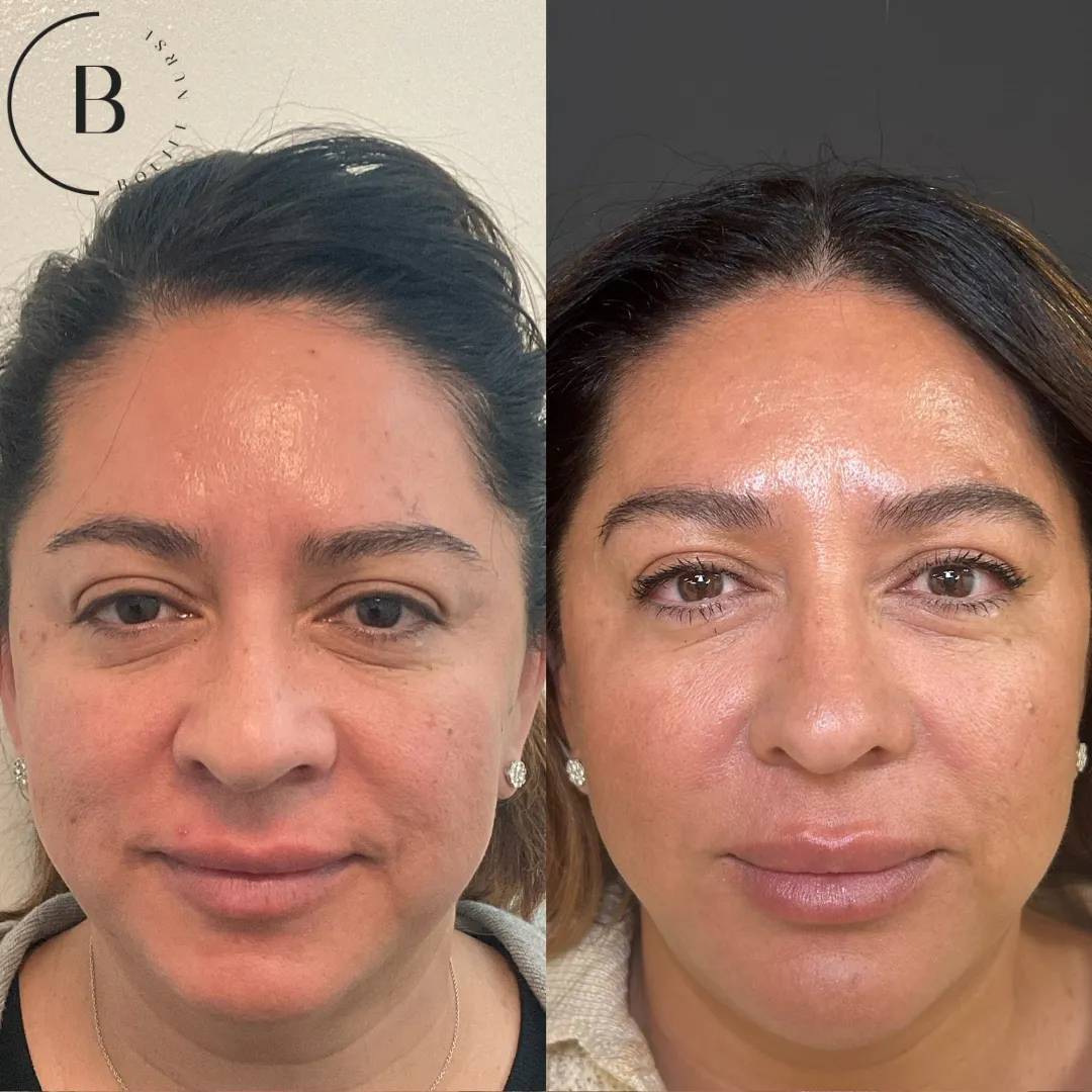 Full Facial Balancing & Skin Rejuvenation before and after results at Boujee Nurse