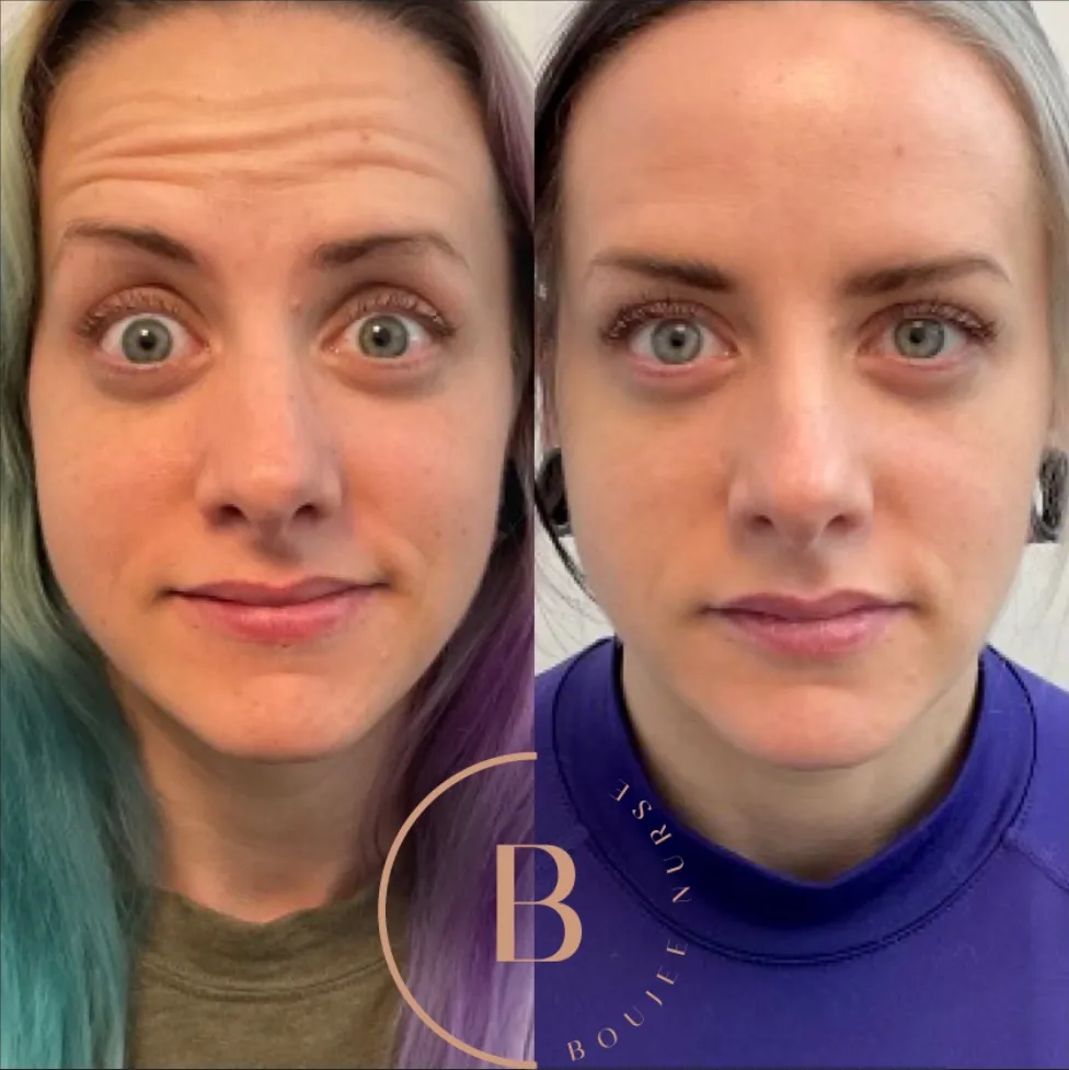 Wrinkle Relaxation before and after results at Boujee Nurse