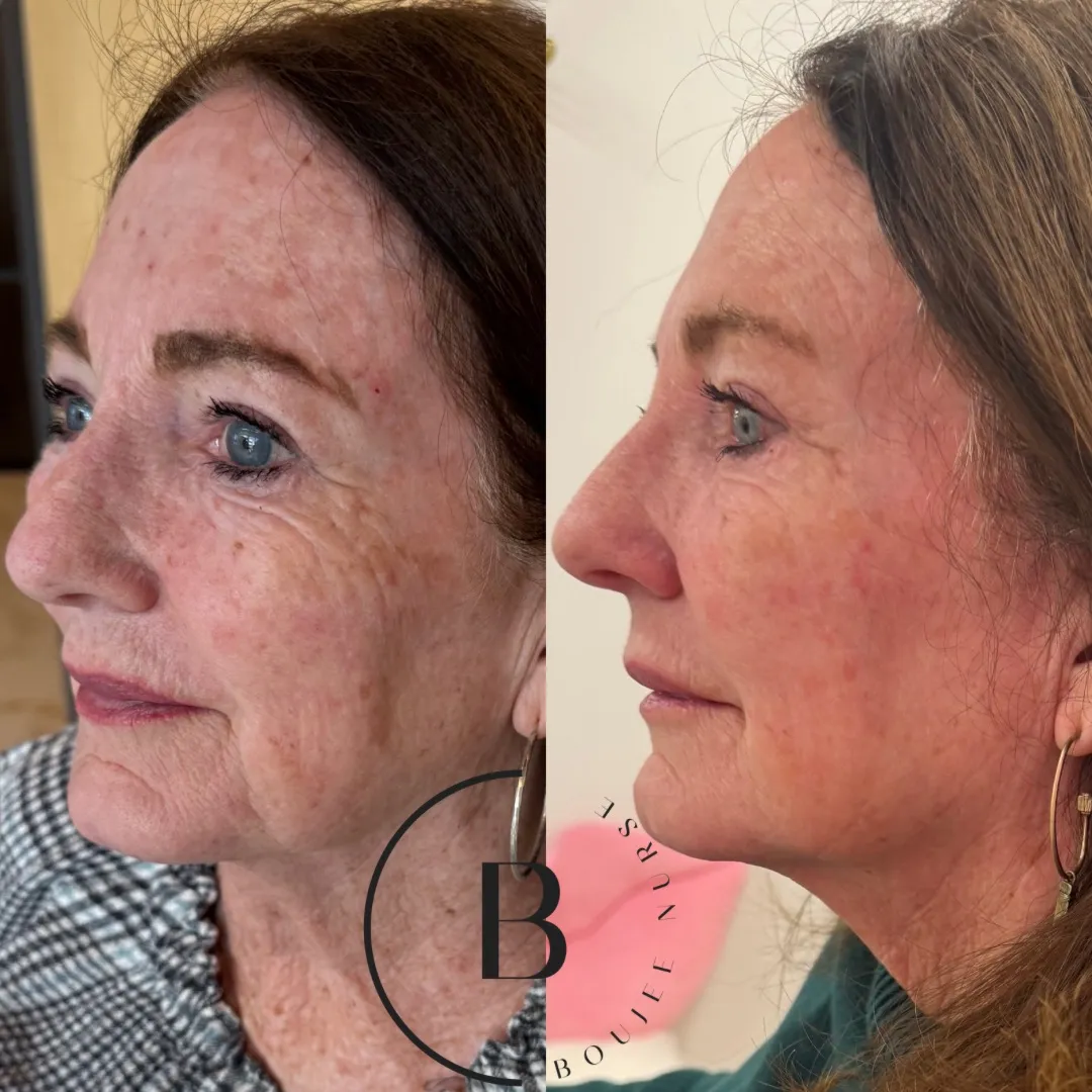 Volume Restoration before and after results at Boujee Nurse