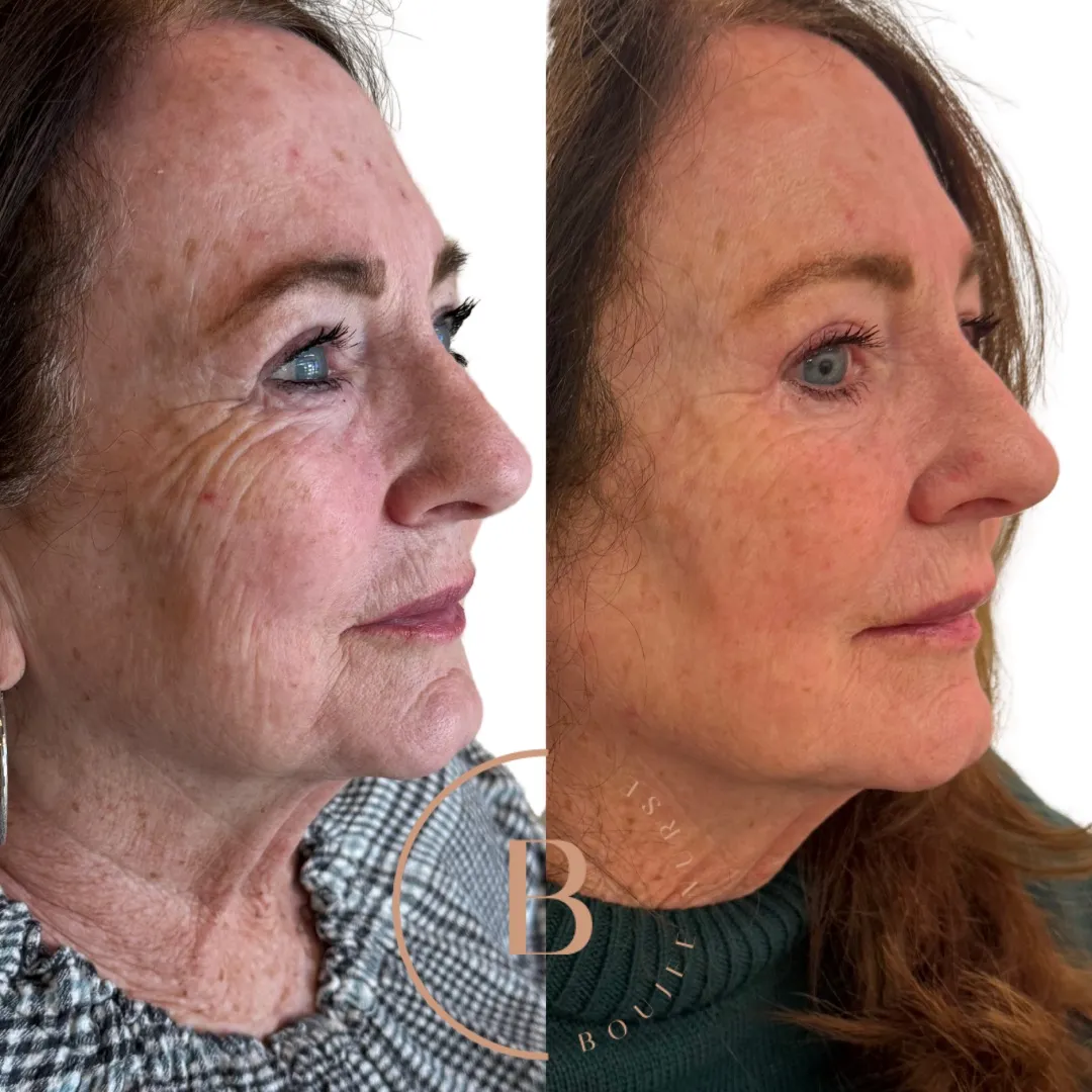 Volume Restoration before and after results at Boujee Nurse