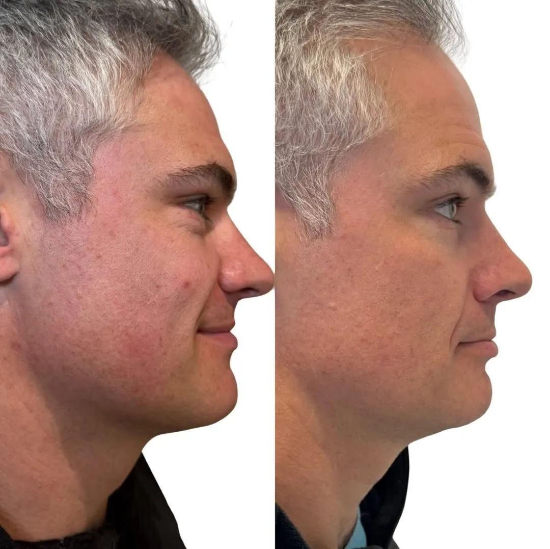 Laser Skin Renewal before and after results at Boujee Nurse