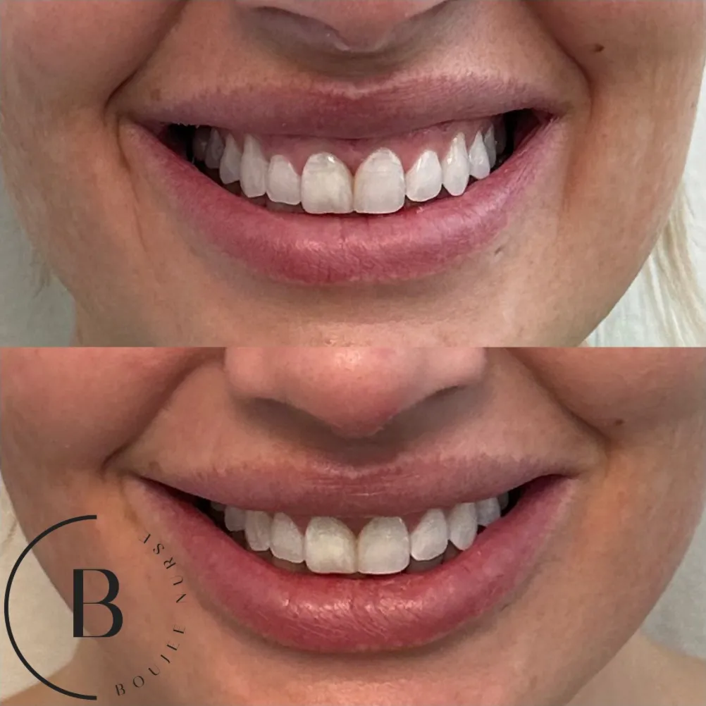 Gummy Smile Correction before and after results at Boujee Nurse