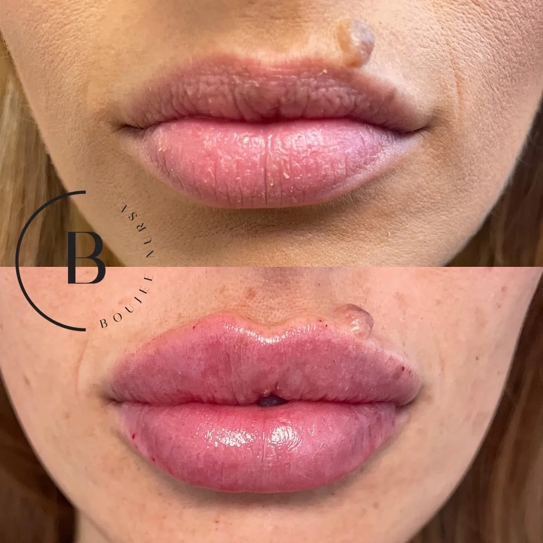 Lip Enhancement before and after results at Boujee Nurse