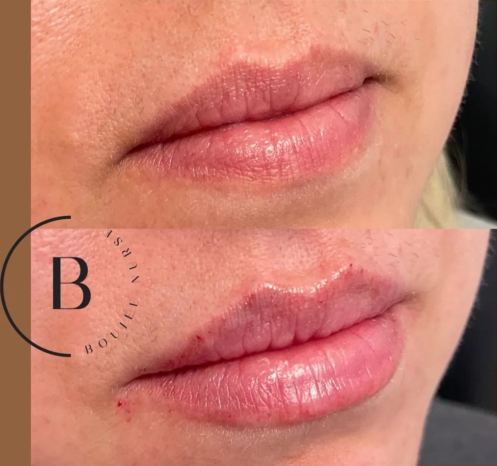 Lip Enhancement before and after results at Boujee Nurse