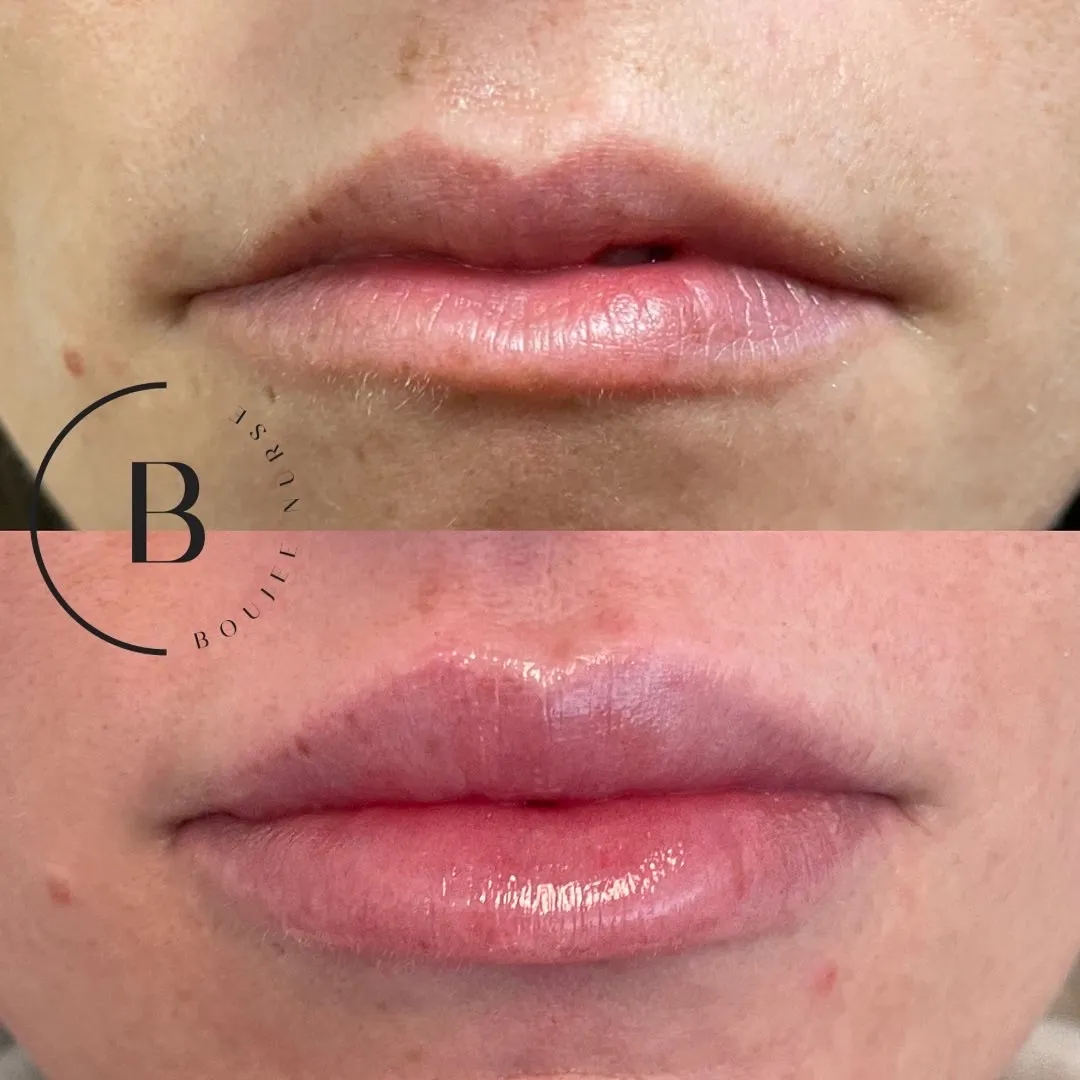 Lip Enhancement before and after results at Boujee Nurse