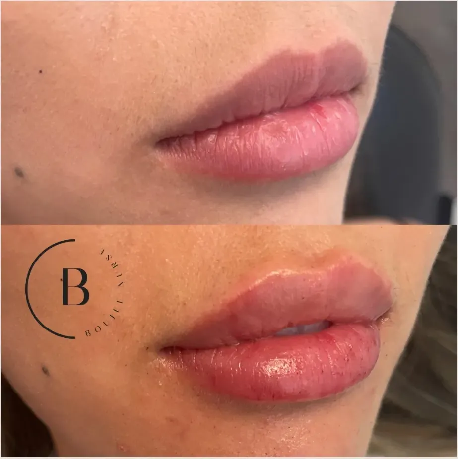Lip Enhancement before and after results at Boujee Nurse