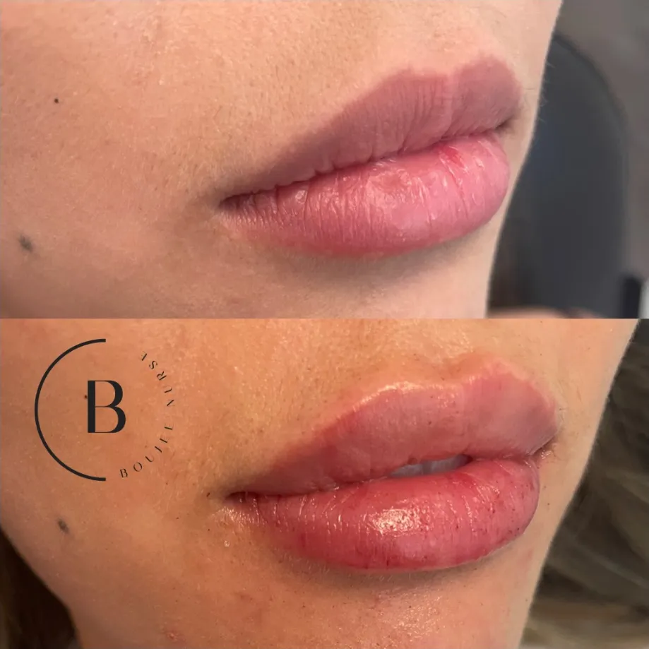 Lip Enhancement before and after results at Boujee Nurse