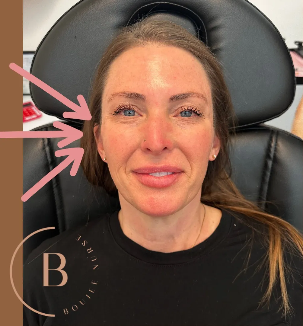 Volume Restoration before and after results at Boujee Nurse