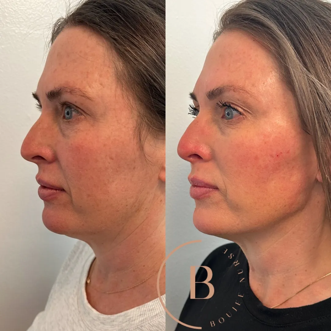 Collagen + Volume Renewal before and after results at Boujee Nurse