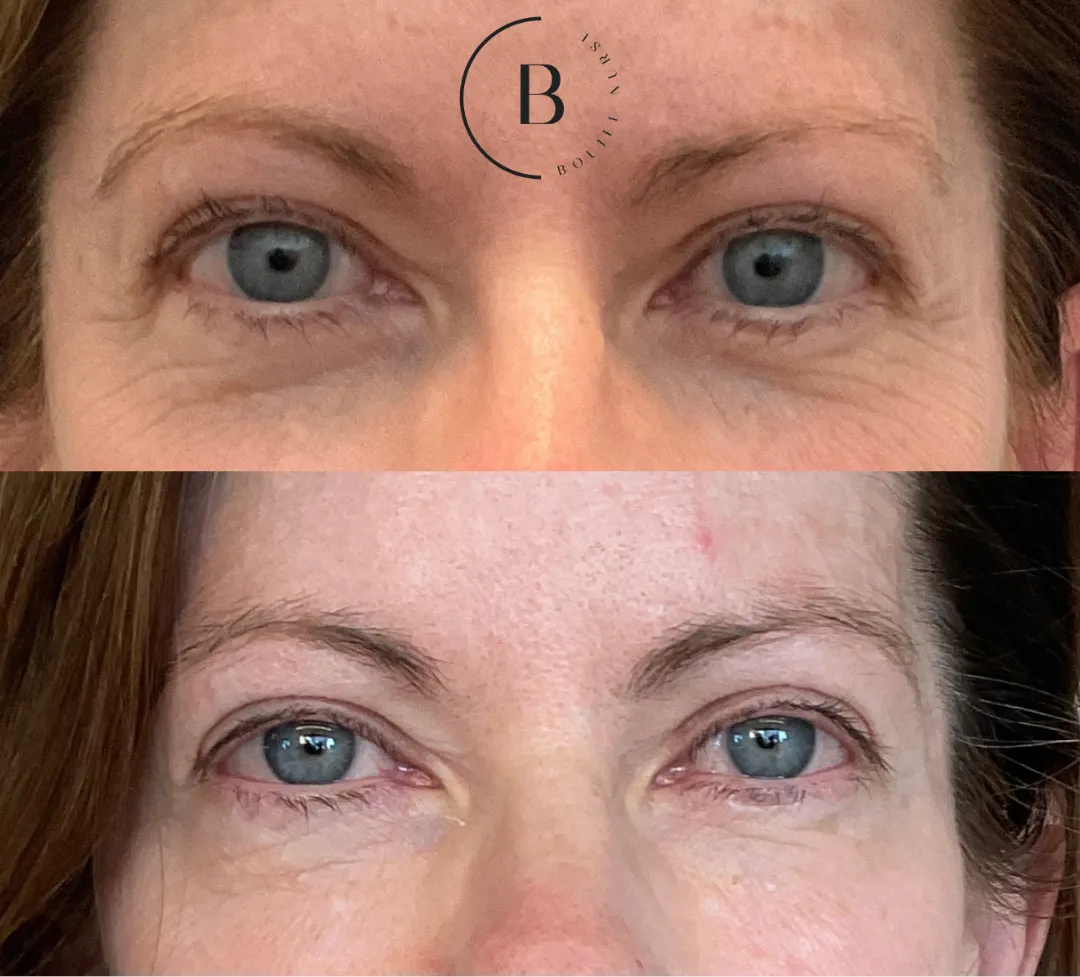 Under-Eye Rejuvenation before and after results at Boujee Nurse