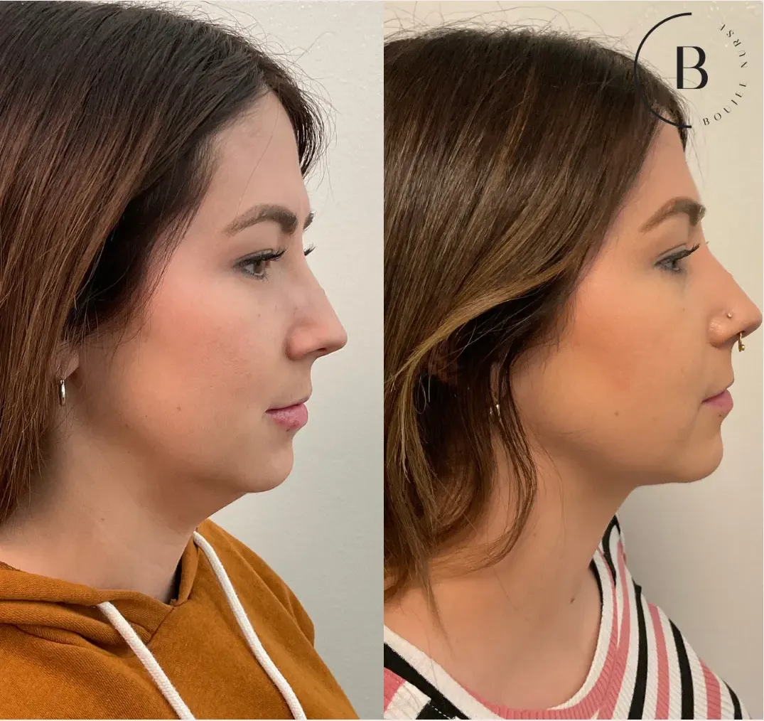 Jawline Refinement before and after results at Boujee Nurse